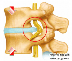 【脊柱】腰突不看年齡，生活習(xí)慣是關(guān)鍵！