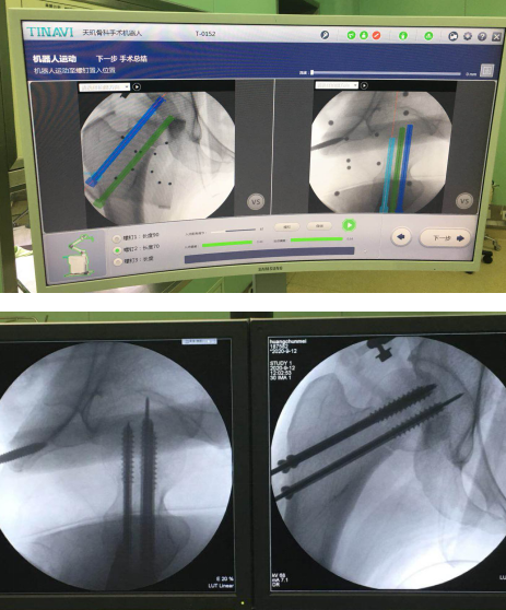 仁慈骨科機器人