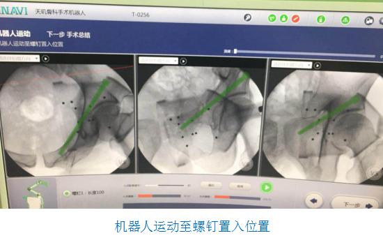 骨科機器人