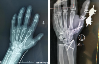 男子被鐵器砸傷，左手五處骨折，骨科機(jī)器人、腕關(guān)節(jié)鏡同上手術(shù)臺(tái)