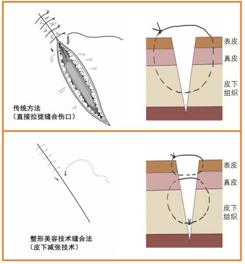 美容縫合